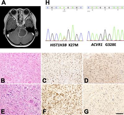 MGMT Expression Contributes to Temozolomide Resistance in H3K27M-Mutant Diffuse Midline Gliomas